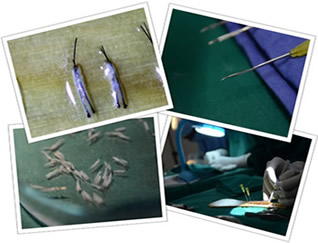 FUT hair transplant Treatment